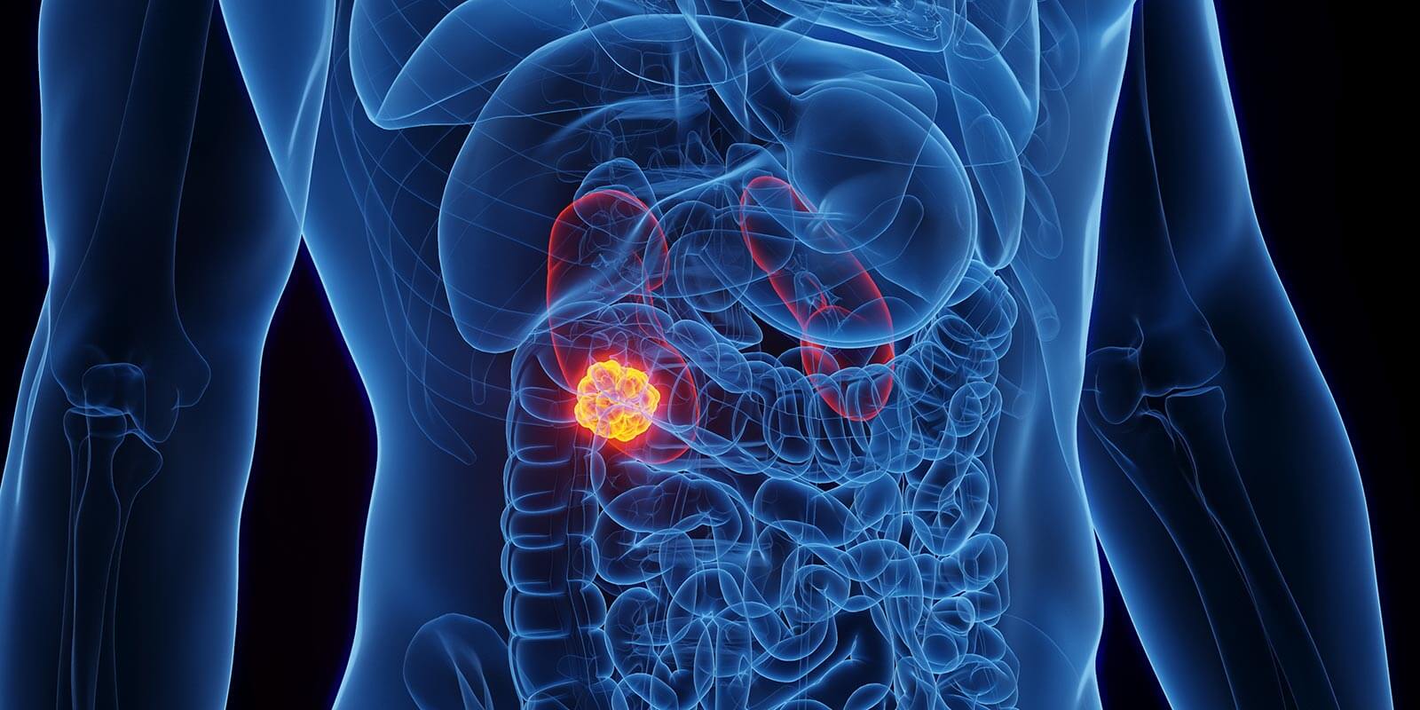 kidney cancer illustration