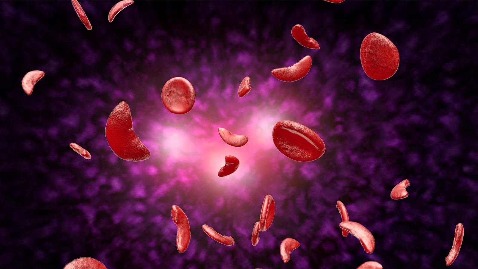 sickle cell anemia illustration