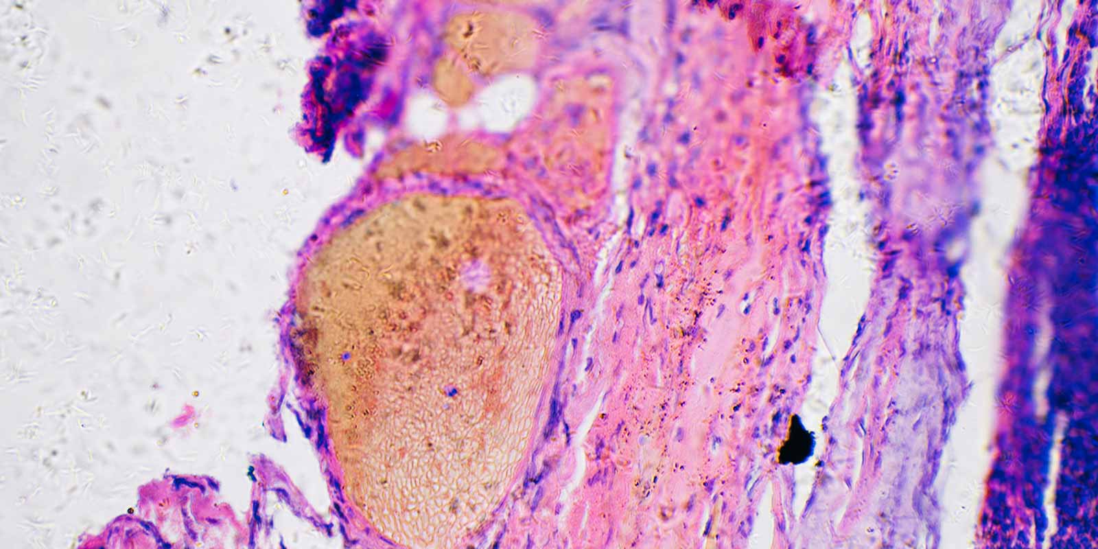 melanoma cancer cells
