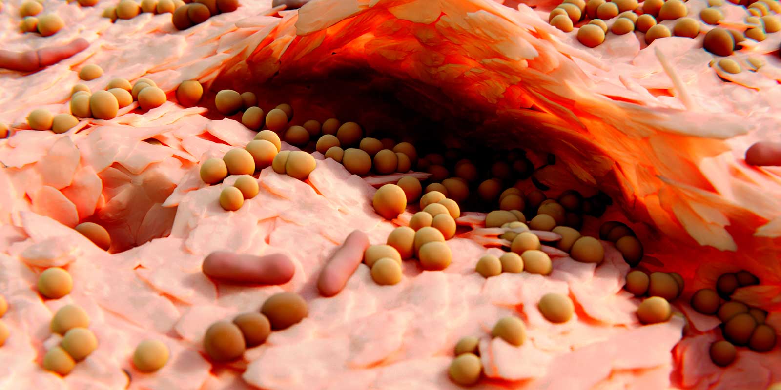 Staphylococcal Neurodermatitis