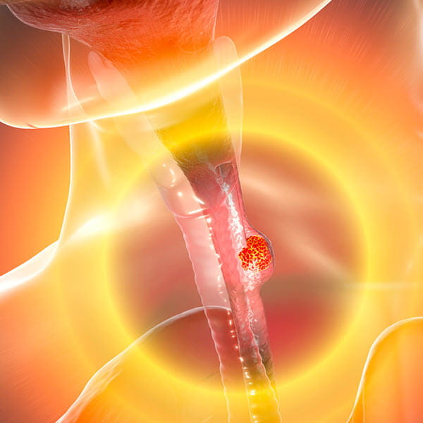 Barrett's Esophagus and Esophageal Cancer