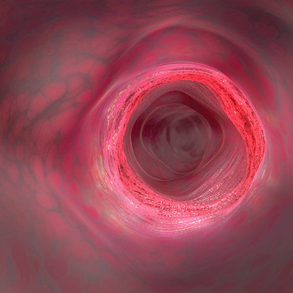 Inflammatory Bowel Disease