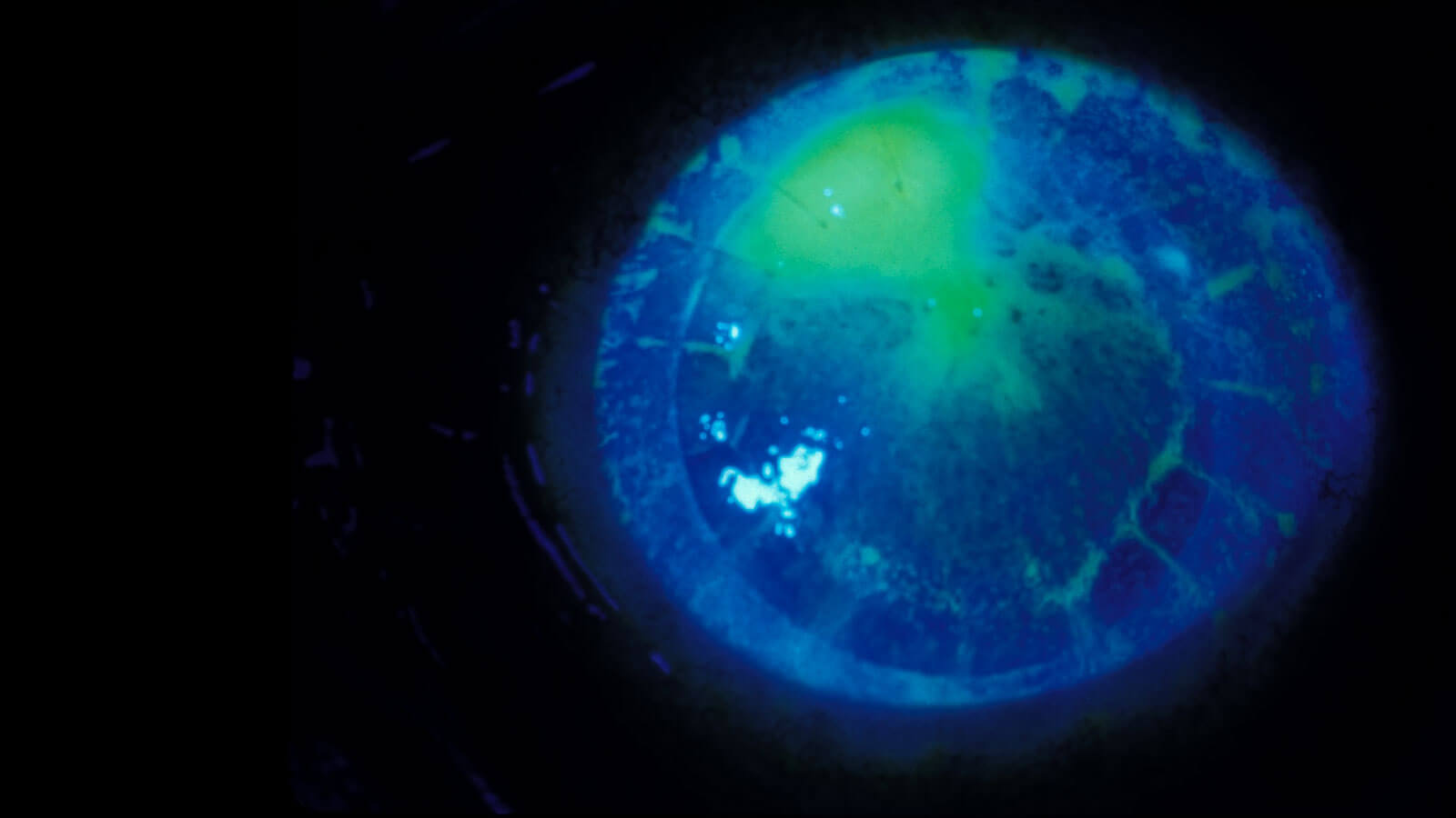 blue and green scan of cornea
