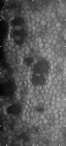 endothelium with dark areas