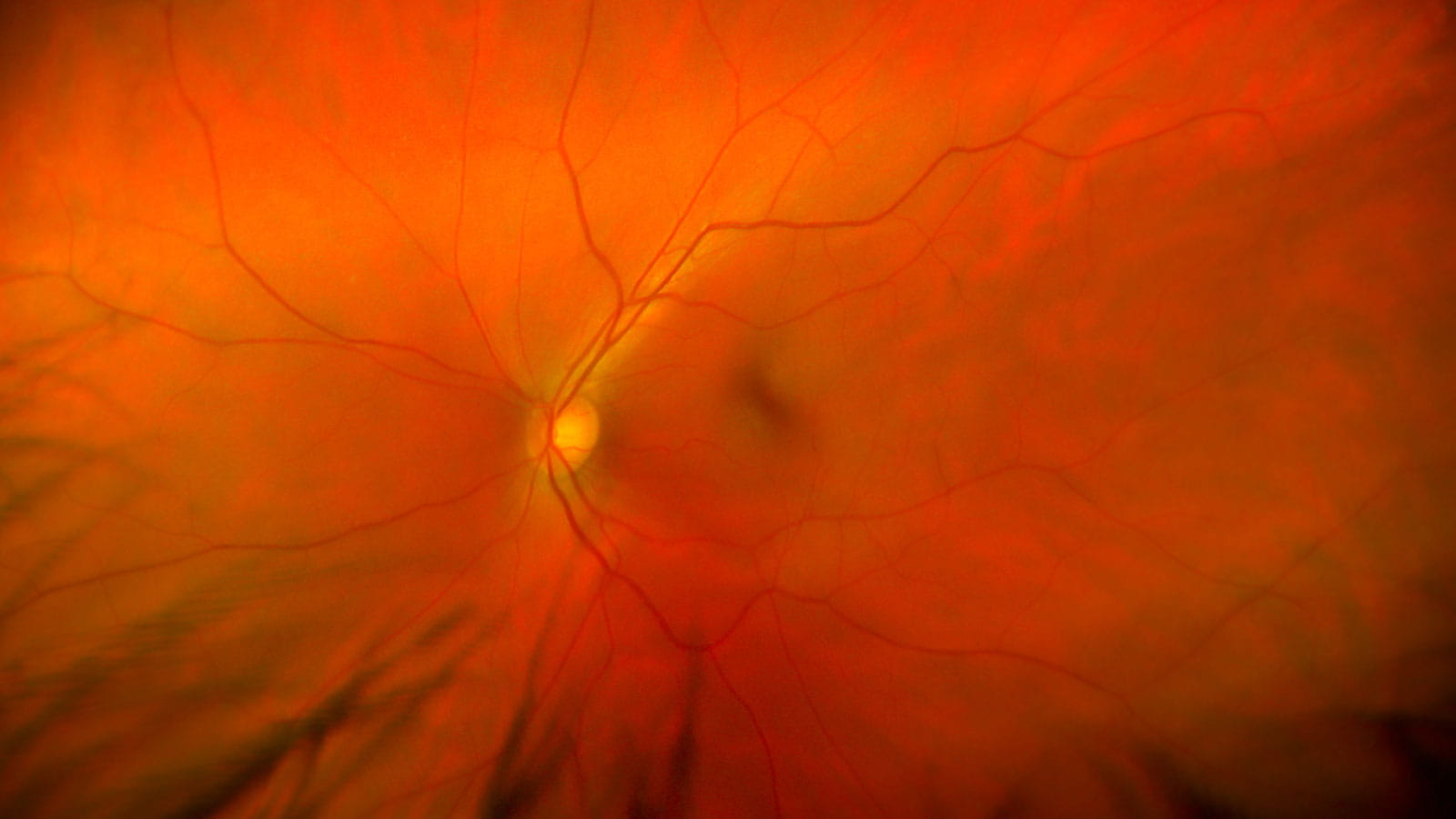 Image of retina