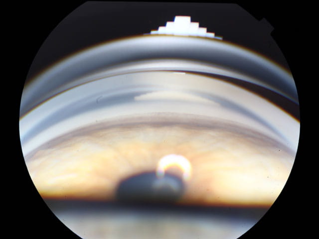 eye scan of the cornea