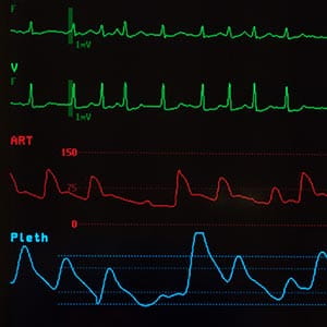 monitor showing atrial fibrillation