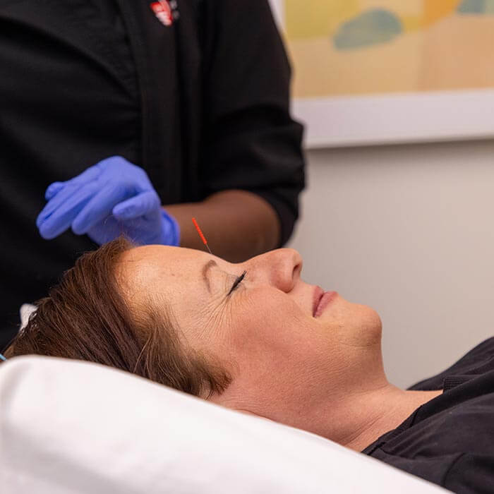 woman getting acupuncture