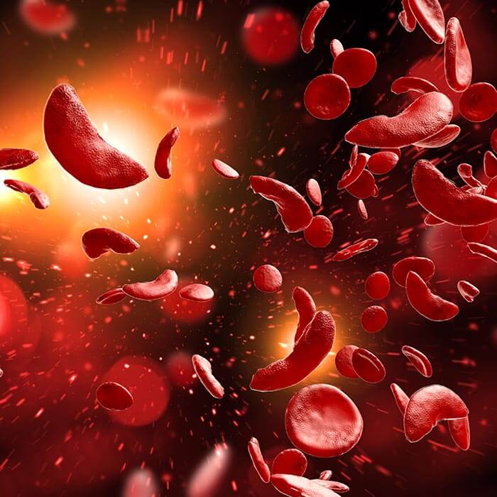 sickle cell anemia