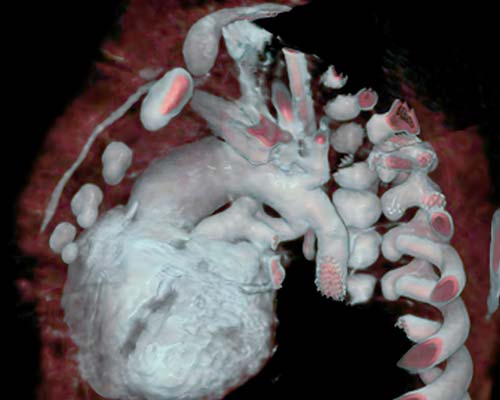 congenital heart malformation