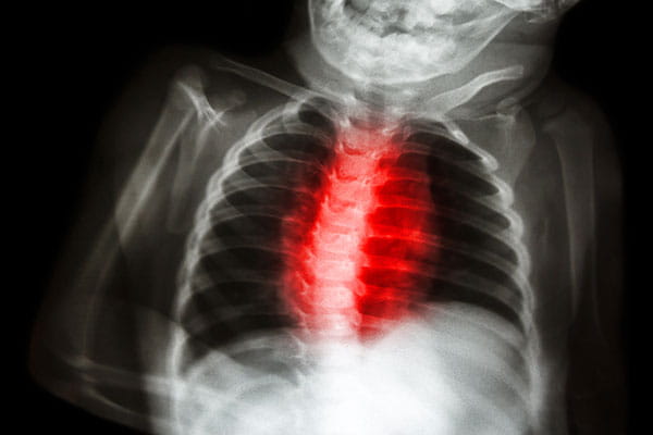 x-ray of newborn with cardiopulmonary disease