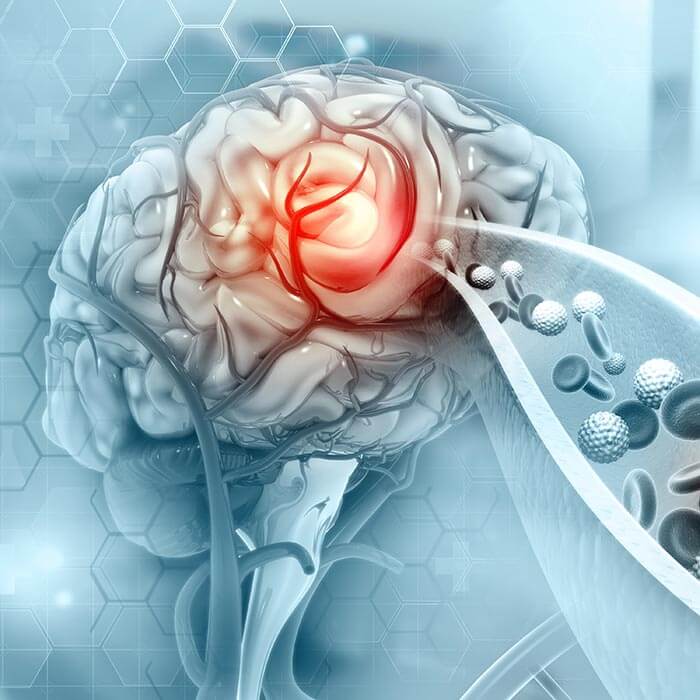 Atherosclerosis Stroke