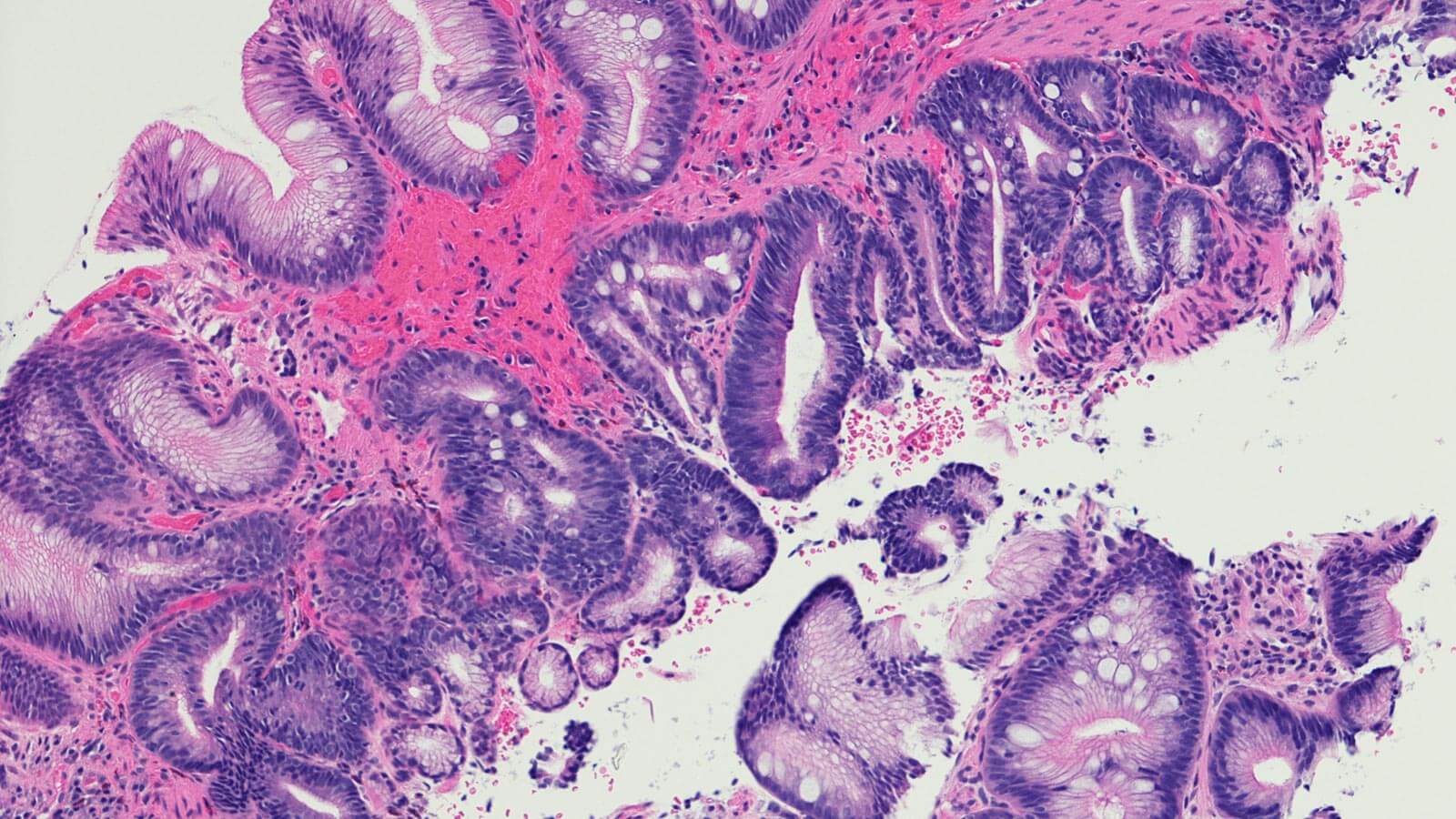 Intestinal metaplasia of the esophagus