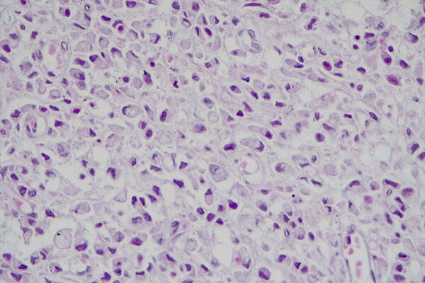 Signet Ring Cell Carcinoma,40x light micrograph