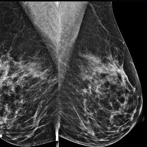 mammography image