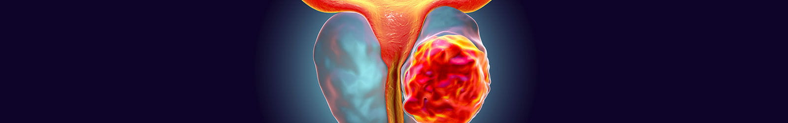 prostate cancer