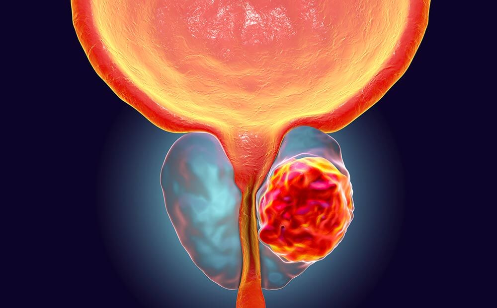 prostate tumor