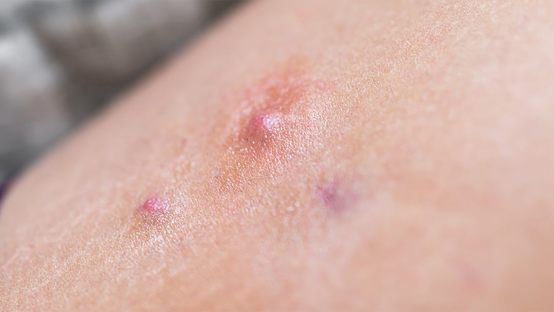 tirzepatide and hidradenitis suppurativa Could Your Symptoms Be Hidradenitis Suppurativa?