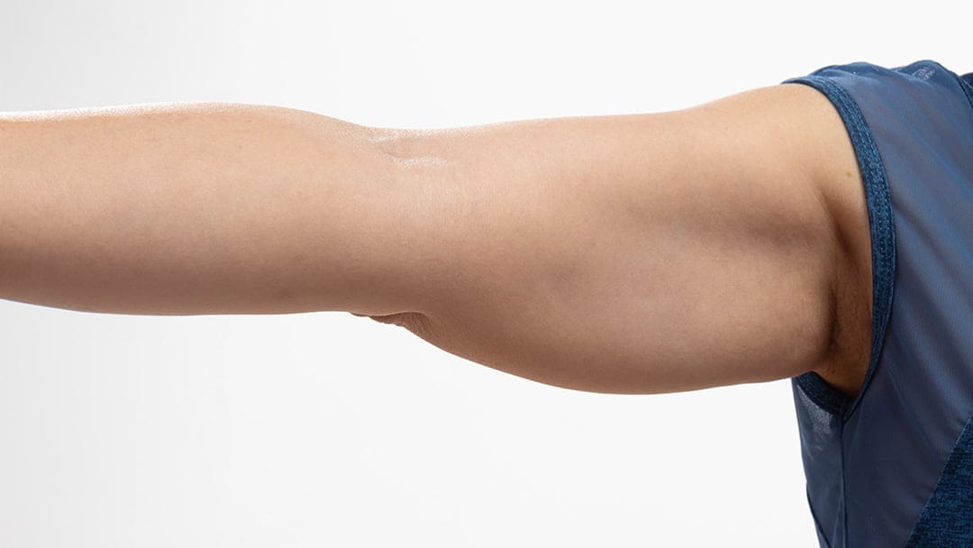 After Weight Loss, Many Face a New Issue: Excess Skin