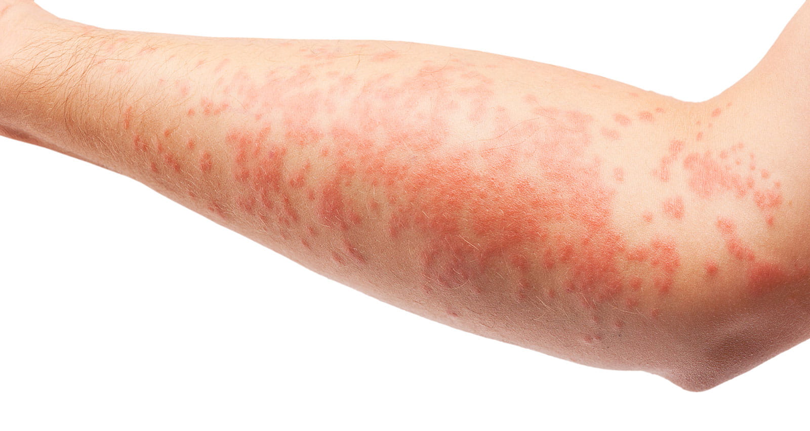 A boy suffering from eczema shows his forearm