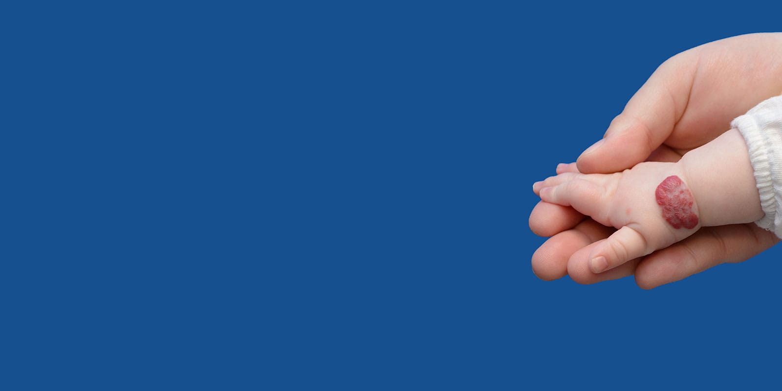 Infants hand showing Hemangioma