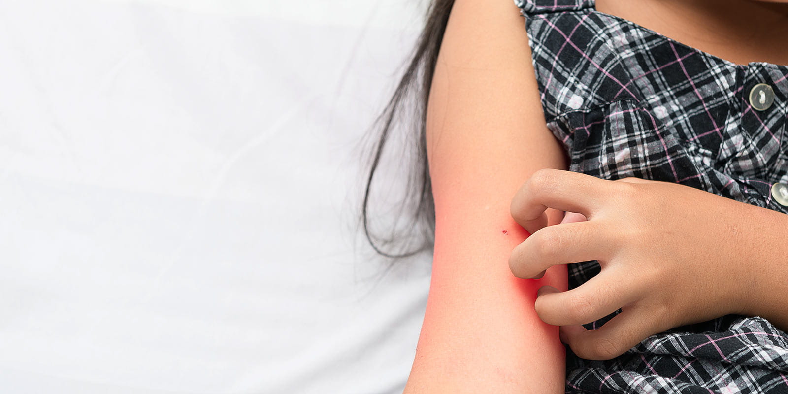 A little girl scratching an inflamed itch on her upper arm with her hand