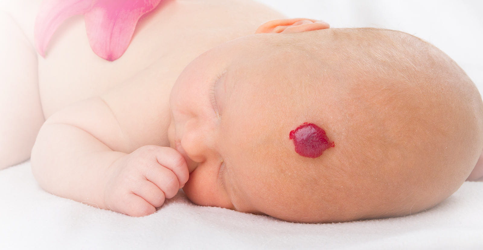 A sleeping little baby with hemangioma