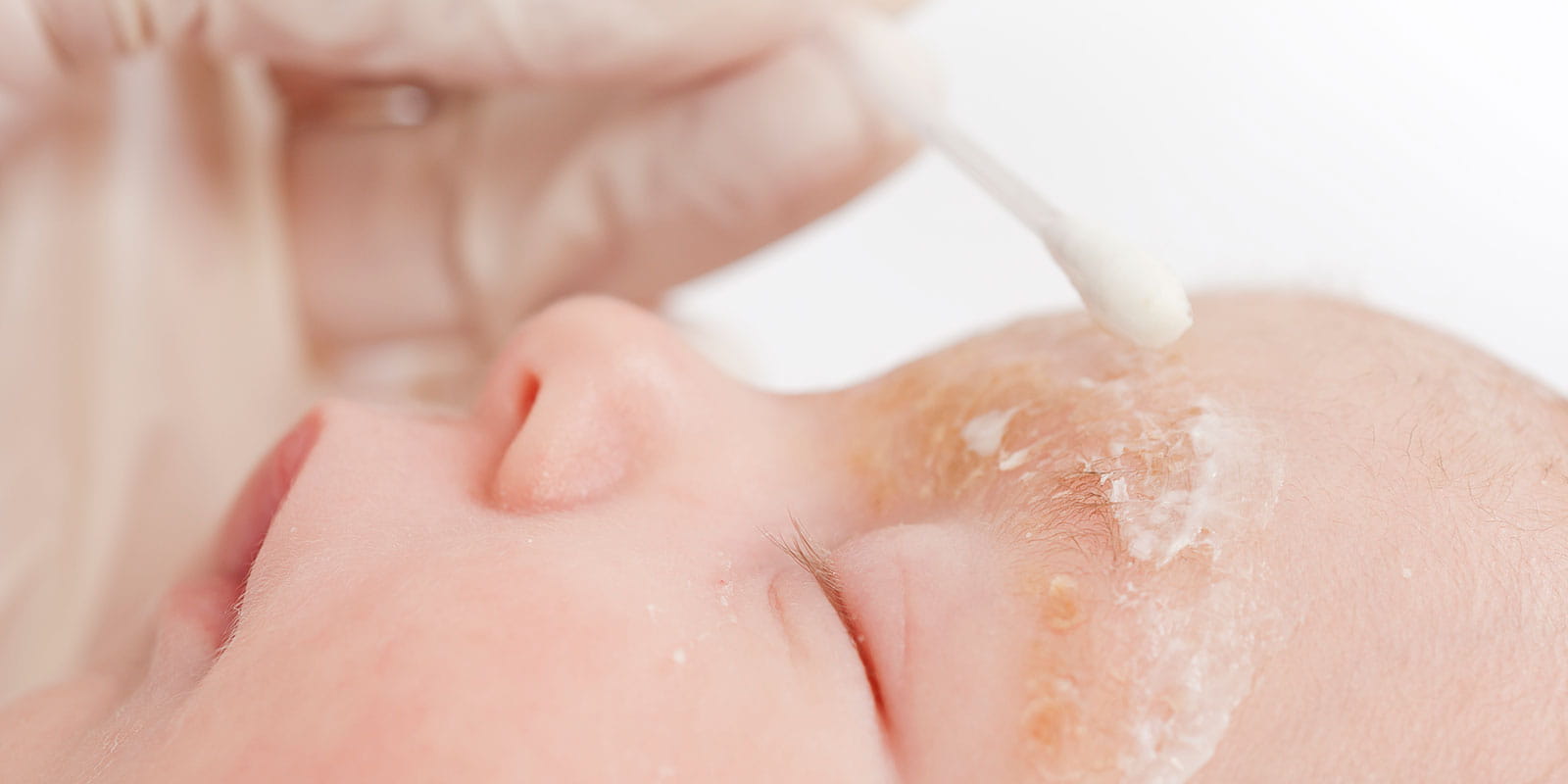 Treatment of seborrheic dermatitis with a healing ointment