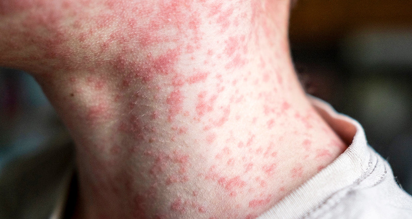 Closeup of a young boy's neck covered in measles