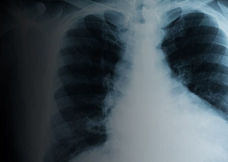 Lung Cancer