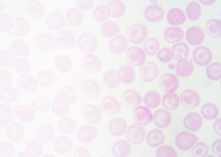 Adult Sickle Cell Disease Clinic