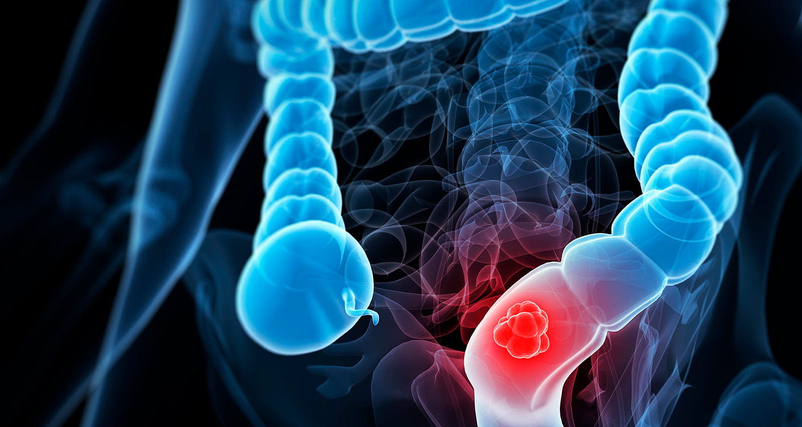 Illustration of colon cancer