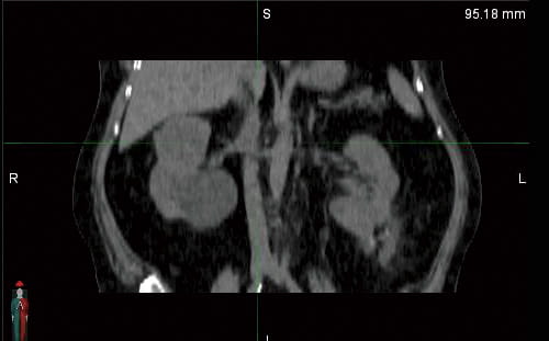 Innovations in Cancer Care | University Hospitals