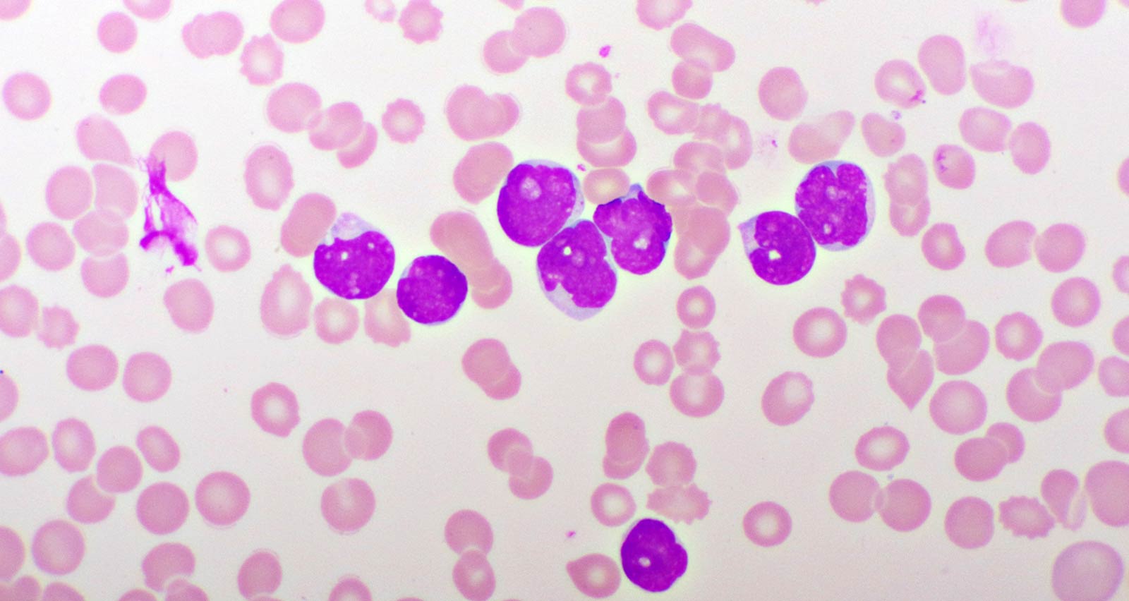 Microscopic picture of acute lymphocytic leukemia