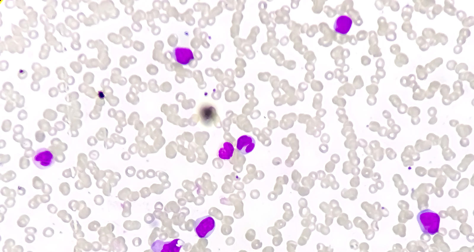 Microscopic view of Acute myeloid leukemia (AML)