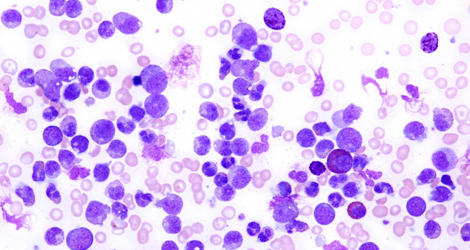 Light micrograph of a blood smear from a patient with chronic myeloid leukemia