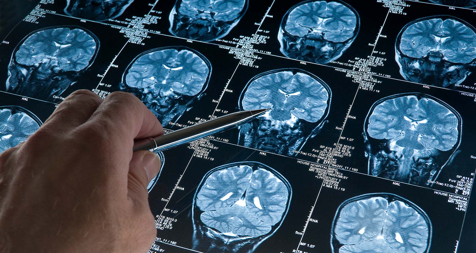 A hand points to images on an MRI Brain Scan of head and skull