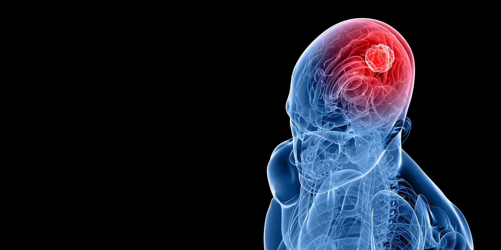 Brain Tumor Illustration