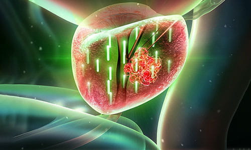 Illustration of Brachytherapy