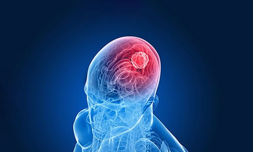 Illustration of Brain and Spine Tumors