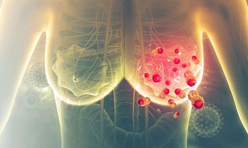 Illustration of Breast Cancer