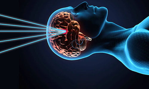 Illustration of Gammaknife Radiosurgery