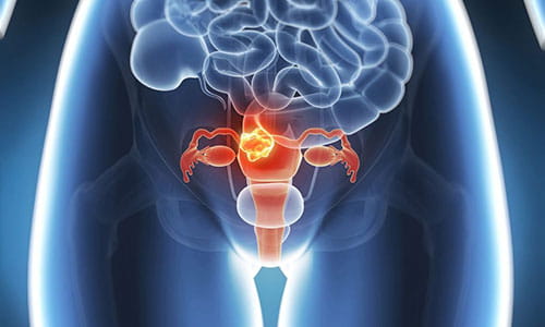 Illustration of Gynecological Cancer