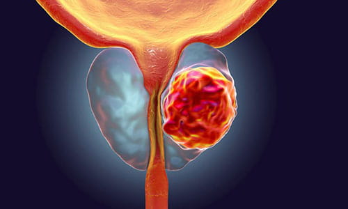 Illustration of Prostate Cancer