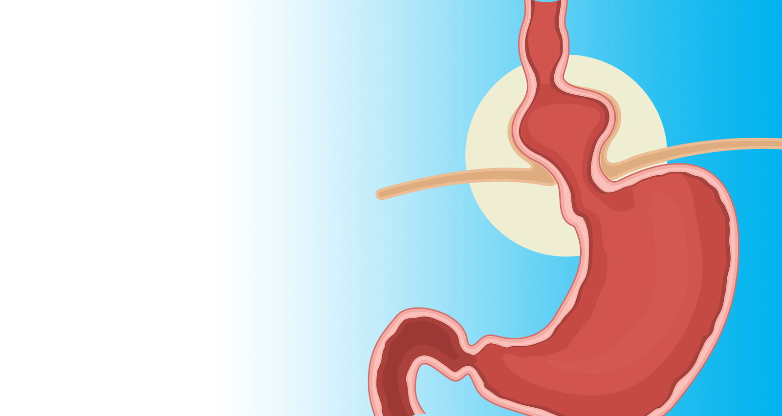 Illustration of a hiatal hernia
