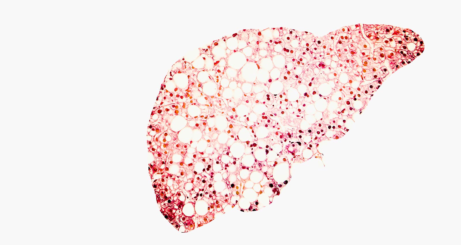 Illustration of fatty liver disease
