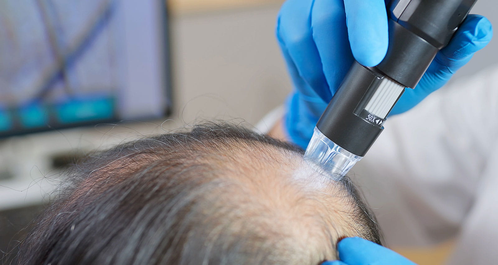 A doctor using medical equipment to examine the scalp of a bald man in a clinic