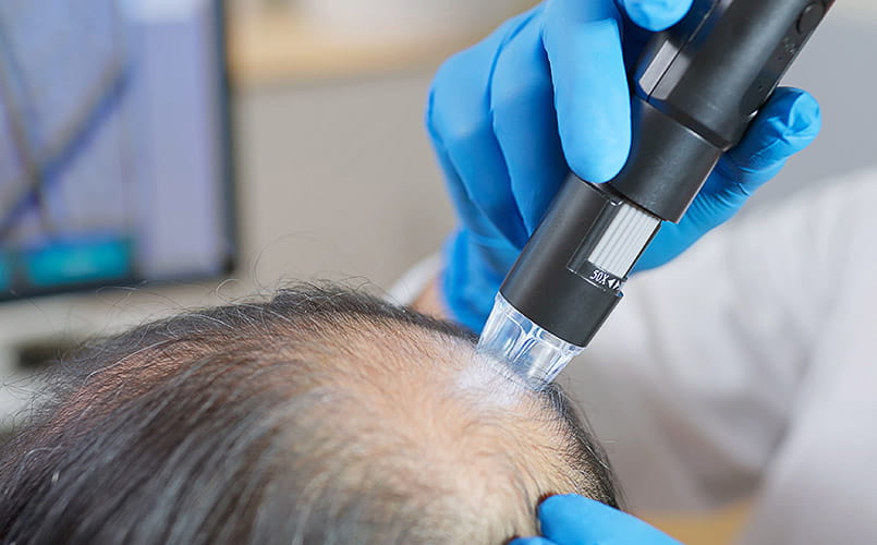 A doctor using medical equipment to examine the scalp of a bald man in a clinic