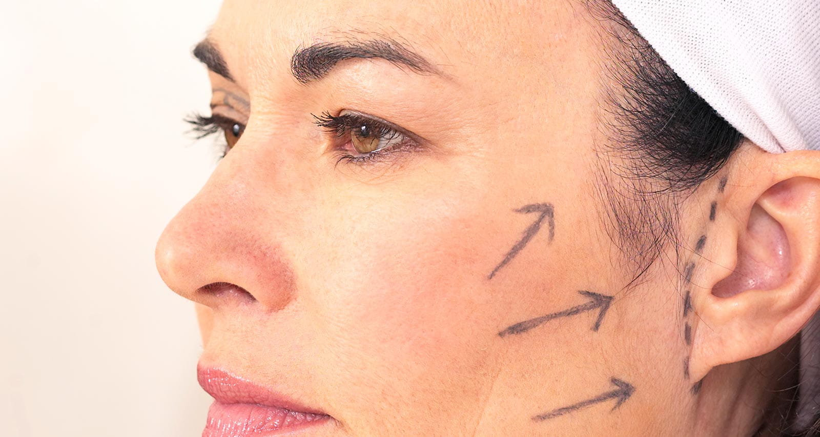The face of a female patient is marked with ink as guides for a procedure