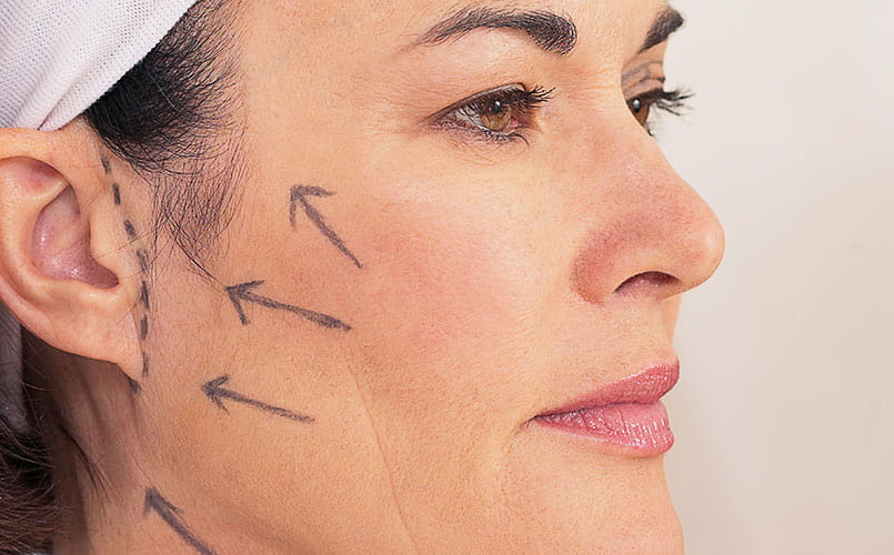 The face of a female patient is marked with ink as guides for a procedure